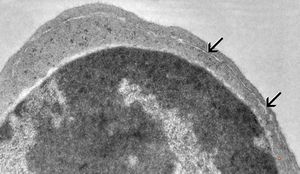 F,1y. | bone marrow … dyserythropoetic anemia v.s. F,1y. | bone marrow … dyserythropoetic anemia v.s.